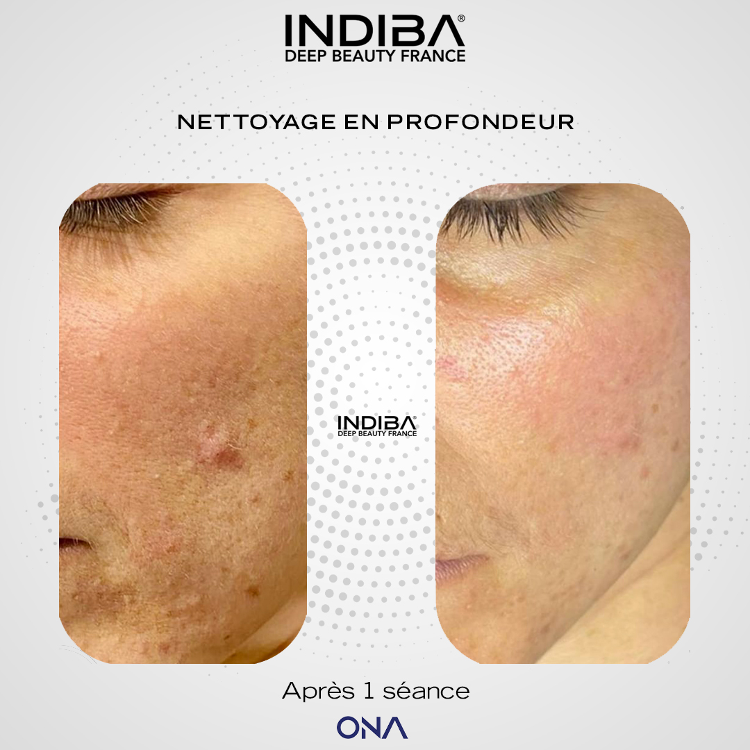 Nettoyage-visage-ONA